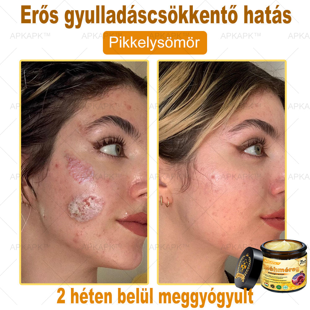 🔥🔥🔥𝐀𝐏𝐊𝐀𝐏𝐊™ 𝐌É𝐇𝐌É𝐑𝐄𝐆 Á𝐓𝐅𝐎𝐆Ó 𝐊𝐑É𝐌🥇𝐀 𝐛ö𝐫𝐩𝐫𝐨𝐛𝐥é𝐦á𝐤 𝐤𝐞𝐳𝐞𝐥é𝐬𝐞 𝐦𝐚𝐠á𝐛𝐚𝐧 𝐟𝐨𝐠𝐥𝐚𝐥𝐣𝐚: é𝐥𝐞𝐭𝐤𝐨𝐫𝐢 𝐟𝐨𝐥𝐭𝐨𝐤, 𝐡𝐞𝐠𝐞𝐤, 𝐬𝐳𝐞𝐦ö𝐥𝐜𝐬ö𝐤, 𝐛ö𝐫𝐧ö𝐯𝐞𝐝é𝐤𝐞𝐤, 𝐭á𝐥𝐲𝐨𝐠𝐨𝐤, 𝐩𝐚𝐭𝐭𝐚𝐧á𝐬𝐨𝐤, 𝐞𝐤𝐜é𝐦𝐚, 𝐩𝐬𝐨𝐫𝐢𝐚𝐬𝐢𝐬, 𝐚𝐜𝐧𝐞 𝐢𝐧𝐯𝐞𝐫𝐬𝐚, 𝐫á𝐧𝐜𝐨𝐤, 𝐛ö𝐫ö𝐫𝐞𝐠𝐞𝐝é𝐬 é𝐬 𝐞𝐠𝐲é𝐛 𝐩𝐫𝐨𝐛𝐥é𝐦á𝐤🔥
